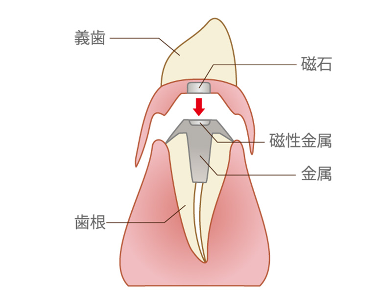東京（綾瀬）の入れ歯専門外来、あやせ ほりきり中央歯科口腔機能クリニックのアタッチメント義歯